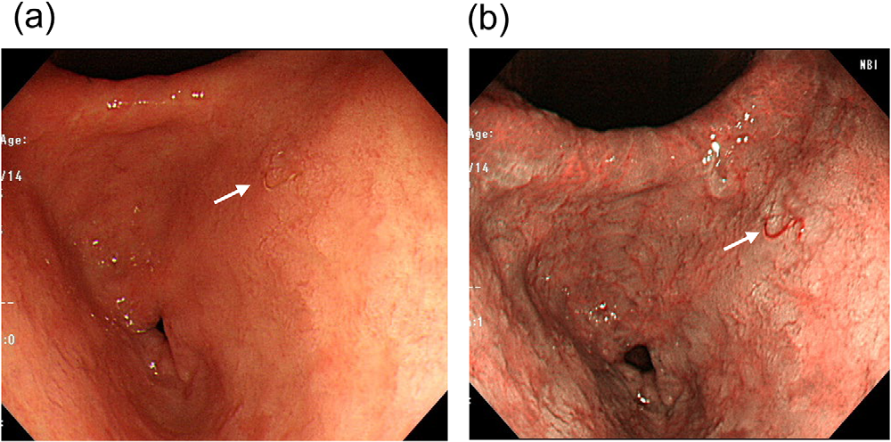 Single hookworm in the gastric antrum, white-light and narrow-band imaging