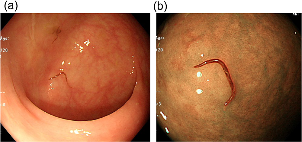 Colonoscopy findings in the terminal ileum, white-light and narrow-band imaging