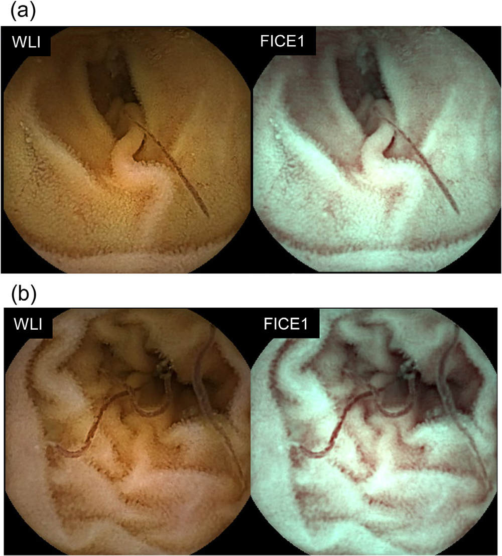 Small-bowel capsule endoscopy, jejunum and ileum, white-light and FICE1 color enhancement