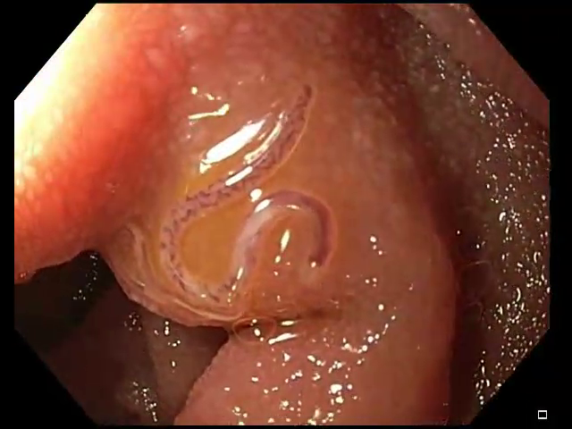 JACI video frame at 0.5 seconds showing NA in the duodenum