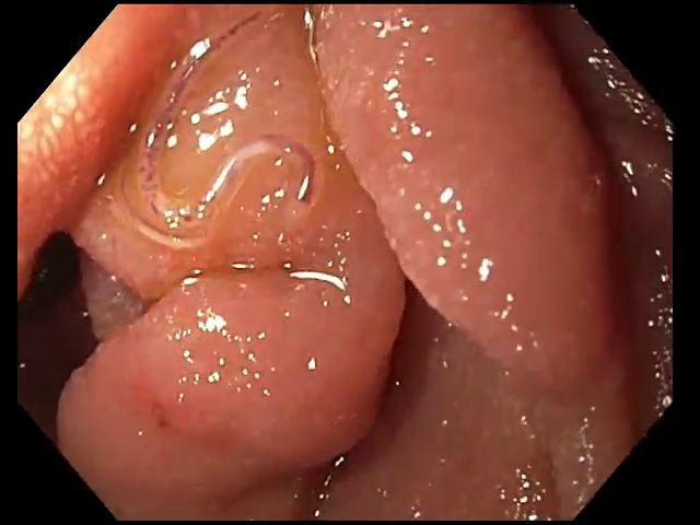 JACI video frame at 13.5 seconds showing NA in the duodenum