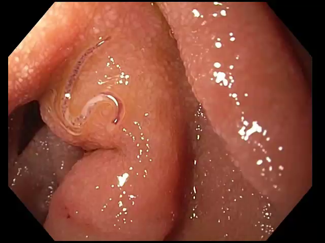 JACI video frame at 14.5 seconds showing NA in the duodenum