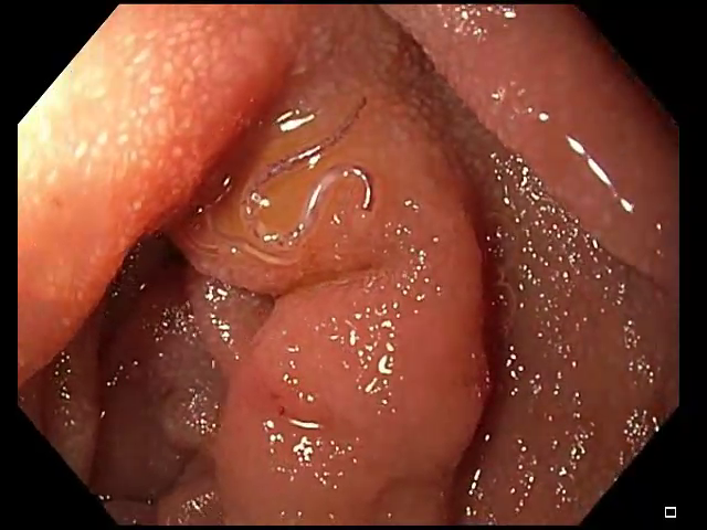 JACI video frame at 4.5 seconds showing NA in the duodenum